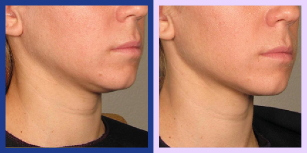 J'ai essayé Ultherapy, le traitement de resserrement de la peau sur les réseaux sociaux. C'est ce que vous devez savoir.