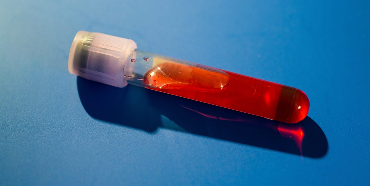 Des scientifiques viennent de développer un test sanguin capable de diagnostiquer la fatigue chronique et le long Covid