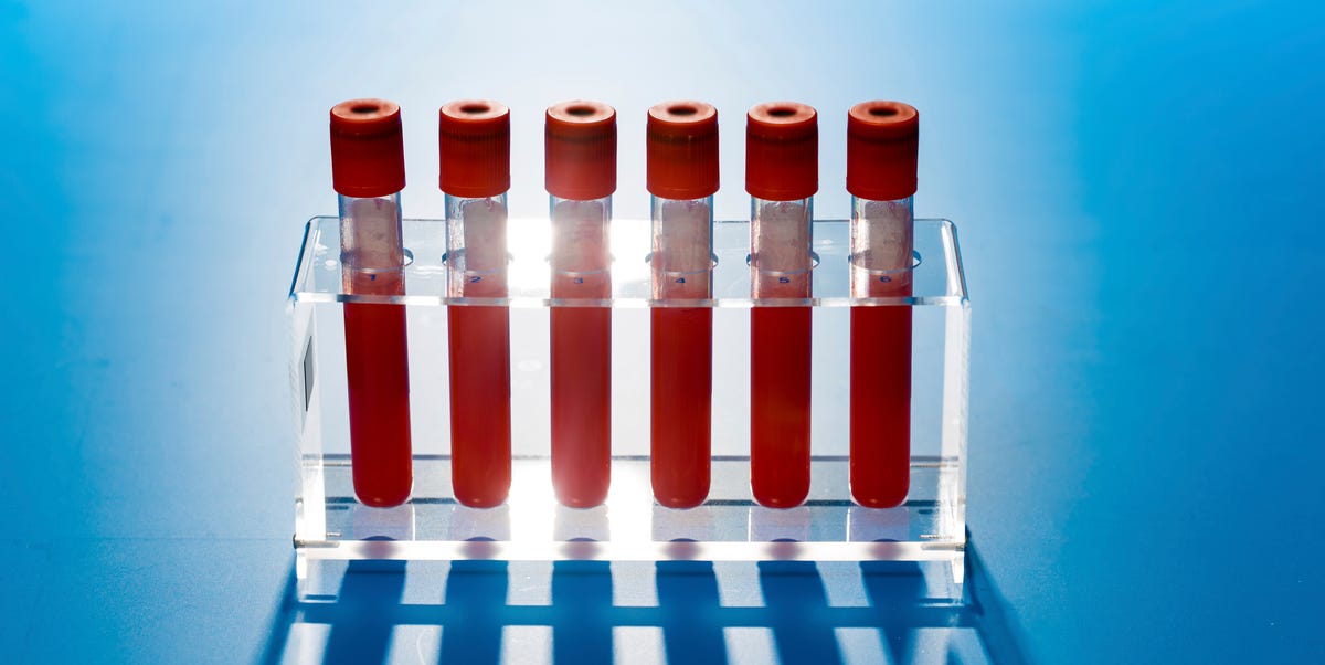 Un simple test sanguin peut-il prédire le risque d’ostéoporose plus tôt que jamais ?