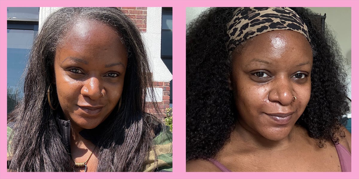 J'ai essayé les traitements Laser Genesis au lieu du Botox. Voici ce que vous devez savoir.